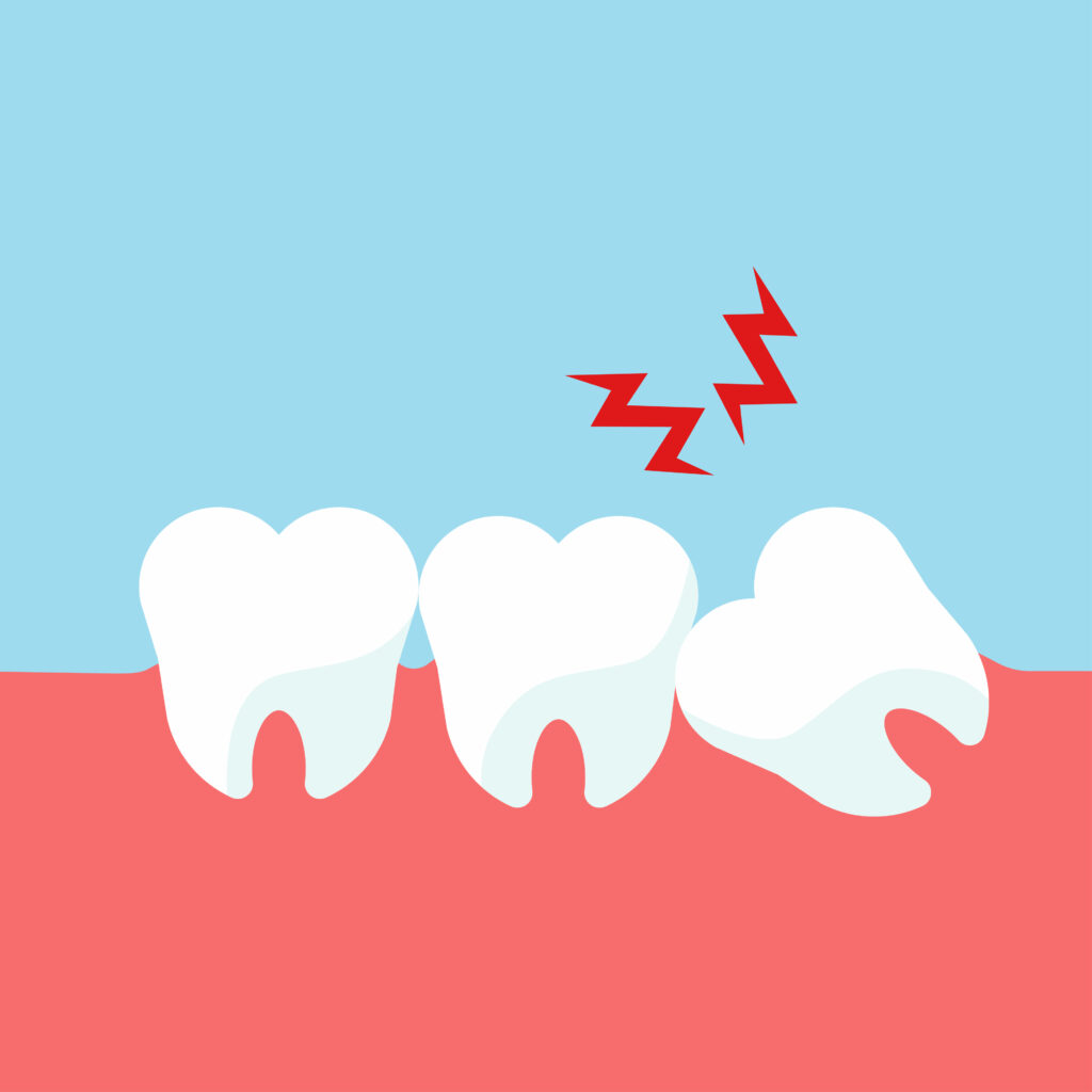 the-need-for-wisdom-tooth-removal-cedar-dental