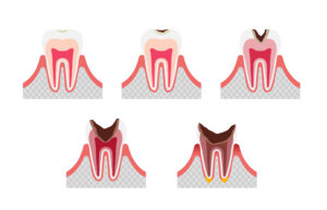 The stages of tooth decay / flat vector illustration set
