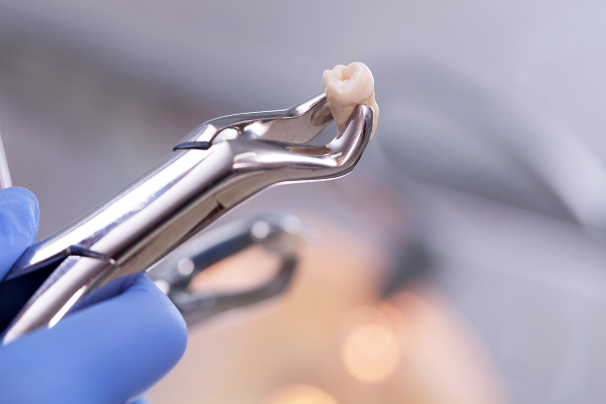 Ways Extraction Can Benefit Your Grin Cedar Dental