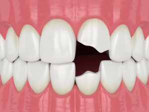 3d render of jaw with broken two incisors teeth