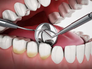 3D illustration showing dentist tools and dental plaque on model. 3D illustration.