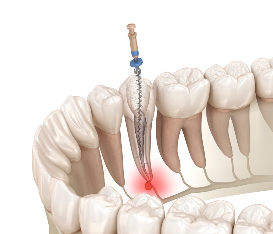 Structural Benefits Of Root Canal Therapy Cedar Dental