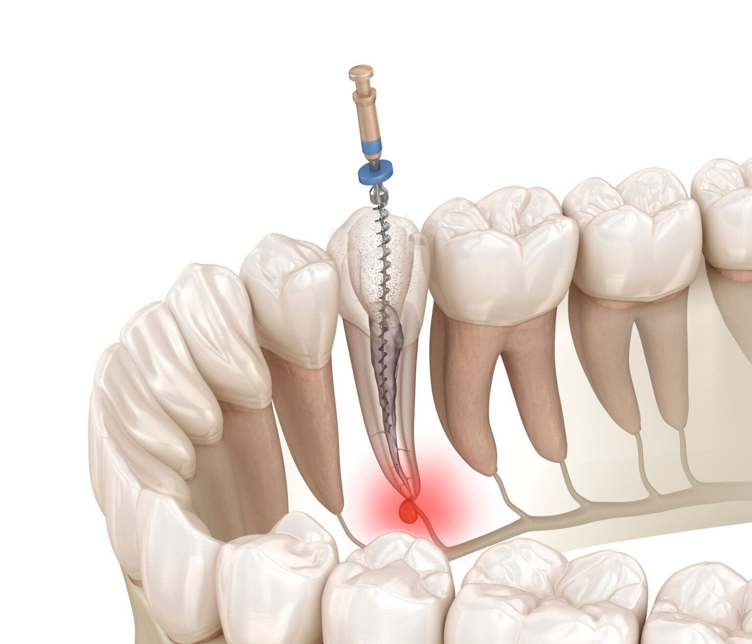 Structural Benefits Of Root Canal Therapy Cedar Dental